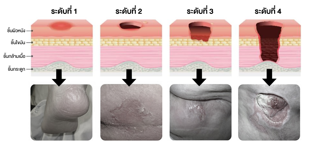 แผลกดทับ 4 ระดับ