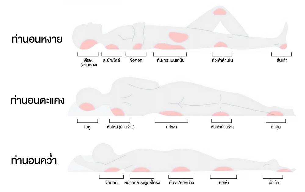 บริเวณที่เกิดแผลกดทับในท่านอน